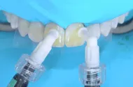Флюороз зубов: опасны ли пятна на зубах?, статья на Eurodent