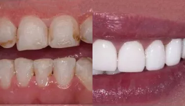 Протезирование зубов с помощью виниров