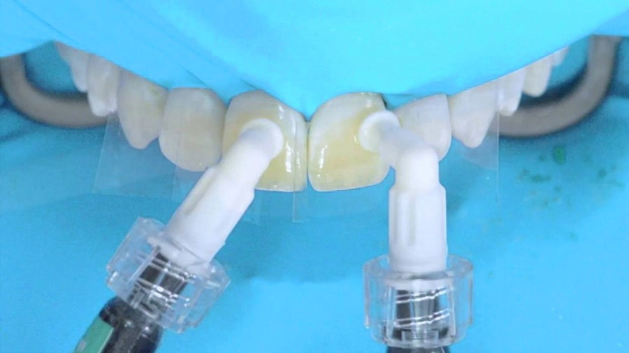 Лечение пятен на зубах, фото Eurodent