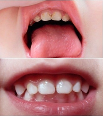 Проявление кариеса молочных зубов, фото 2 и результаты