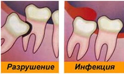 последствия для зубов при росте зуба мудрости