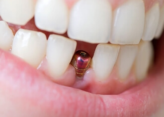 зубной имплант после операции, фото