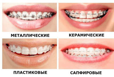 Выбор брекетов, фото №2