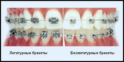 Выбор брекетов, фото №4