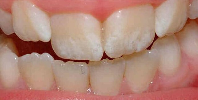 дефекты эмали зуба
