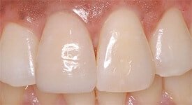 здоровая эмаль зуба после лечения