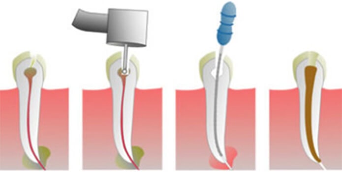 процесс удаления нерва зуба