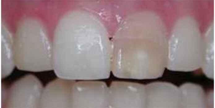 здоровые зубы без боли