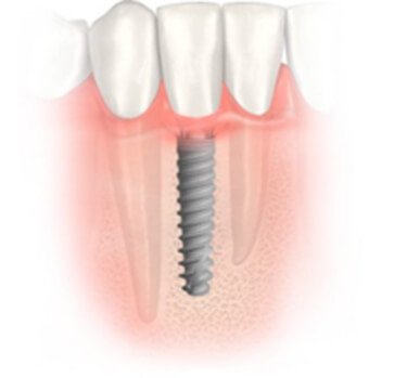 качественные зубные импланты нобел