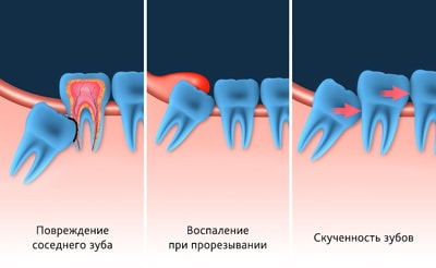 Удаление зуба при повреждении