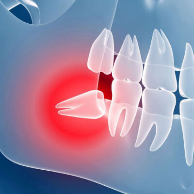 На изображении челюсть человека - рентгеновский снимок, на котором видно воспаление  из-за зуба мудрости, Евродент фото