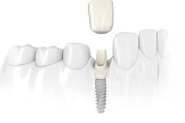 Экспресс имплантация зубов – быстрое восстановление красивой улыбки