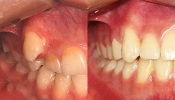 Исправление прикуса при помощи металлических брекетов