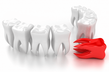 Гемисекция зуба: вопросы и ответы