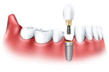 Имплантация зубов или протезирование: выбираем лучшее!
