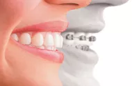 Элайнеры или брекеты: что лучше выбрать для выравнивания зубов, статья на Eurodent