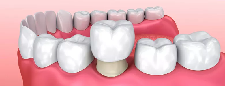 Керамические зубные коронки