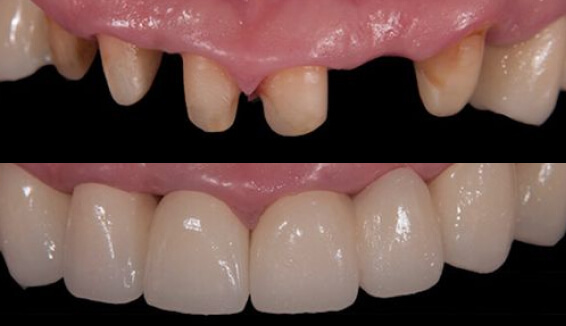 Установка циркониевых коронок