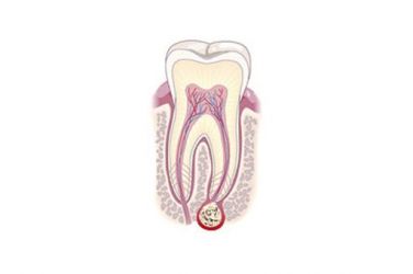 Гранулема зуба: лечение и причины возникновения заболевания