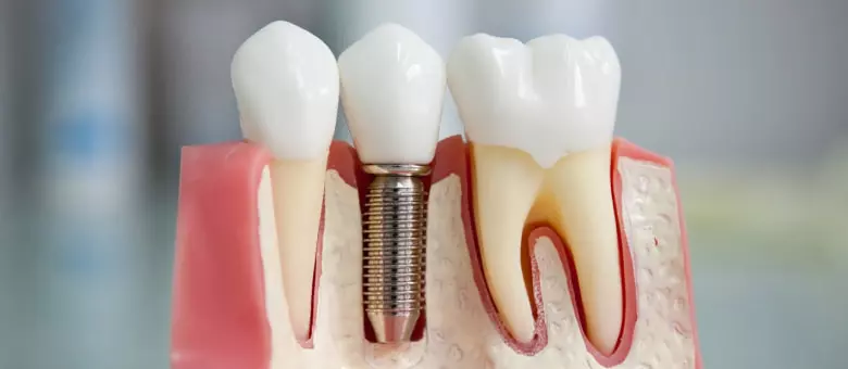 Имплантация зубов, направление на сайте Eurodent