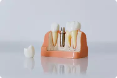 Протезирование зубов, направление на сайте Eurodent