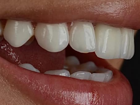 Установка новых виниров