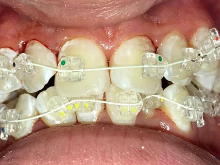 Коррекция прикуса с помощью брекетов
