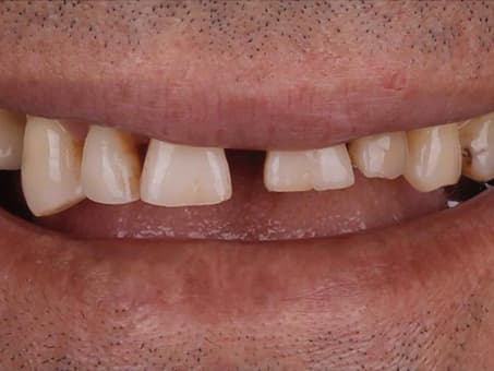 Установка виниров E-max