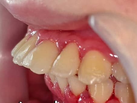 Коррекция прикуса без операции