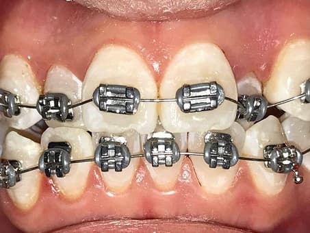 Корректировка прикуса брекетами