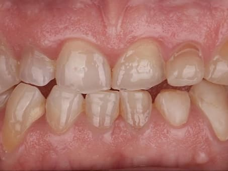 Тотальное восстановление зубов винирами и коронками E-max