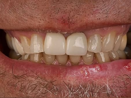 Замена металлокерамических коронок на виниры