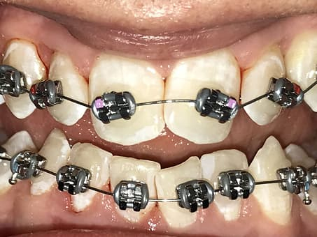 Исправление прикуса металлическими брекетами
