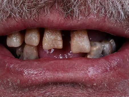 Восстановление зубного ряда имплантами