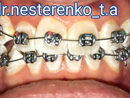 Восстановление прикуса брекетами
