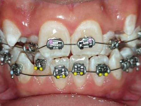 Исправление прикуса с помощью брекетов