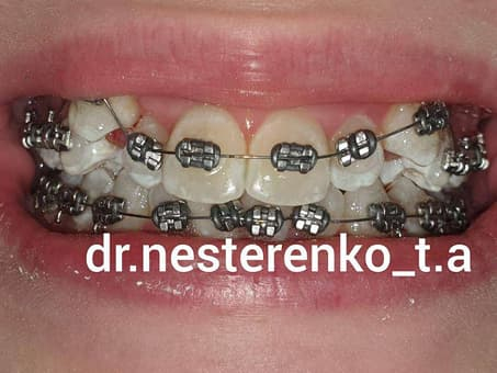 Восстановление улыбки брекетами