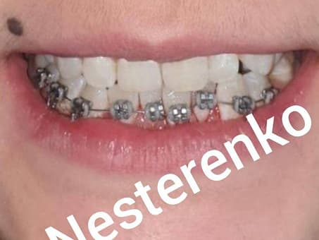Выравнивание зубов металлическими брекетами