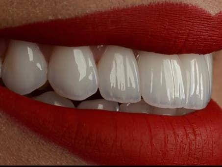 Установка новых виниров