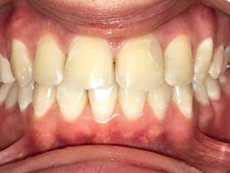 Коррекция прикуса с помощью брекетов