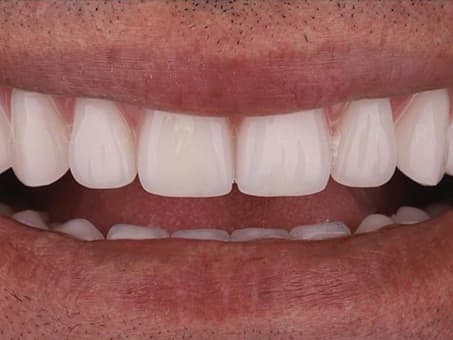 Установка виниров E-max