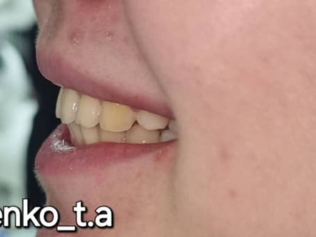 Коррекция прикуса без операции