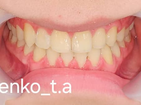 Корректировка прикуса для здоровой улыбки