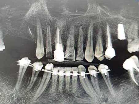 Плановая имплантация при болезни Бехтерева