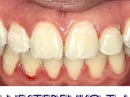 Корректировка прикуса брекетами