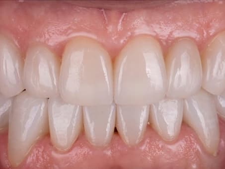 Тотальное восстановление зубов винирами и коронками E-max