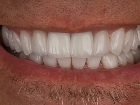 Замена металлокерамических коронок на виниры