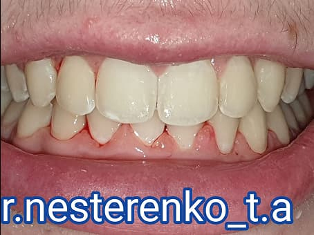 Исправление прикуса металлическими брекетами