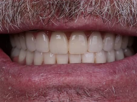 Восстановление зубного ряда имплантами