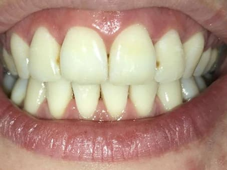 Выравнивание зубов с помощью брекетов